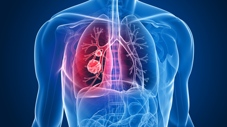 MT1801_Lung Cancer_47781766_1200