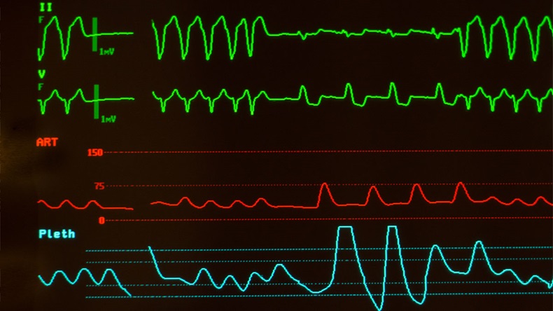 Ventricular tachycardia and intraventricular conduction delay on green lines, arterial blood pressure on red line and oxygen saturation or plethsmography on blue line on a monitor with black screen. - Image 