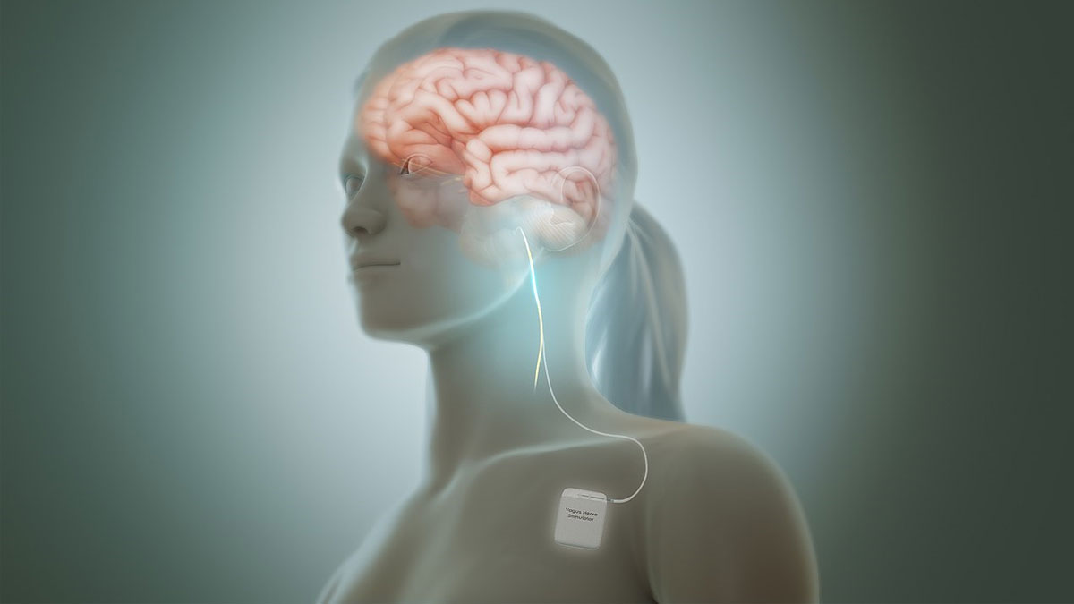 Vagus Nerve Stim Gets New Chance To Prove Its Worth For Depression