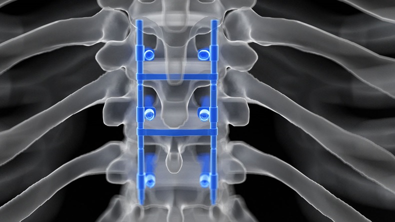 3d rendered medically accurate illustration of a spinal fusion - Illustration 