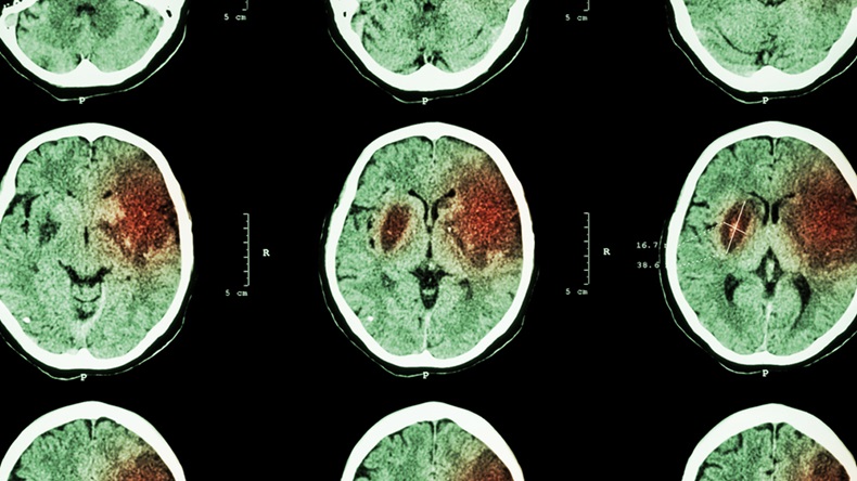 Ischemic stroke : ( CT of brain show cerebral infarction at left frontal - temporal - parietal lobe ) ( nervous system background ) - Image 