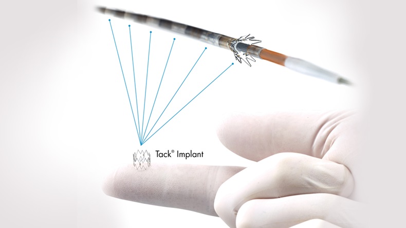 Vascular’s Tack Peripheral Dissection Repair Device