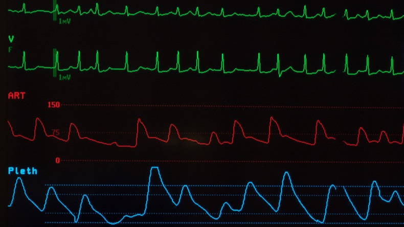 Medical monitor with green lines of an abnormal ECG showing atrial fibrillation, a red line for the arterial blood pressure and a blue line for the oxygen saturation against a black background. - Image 