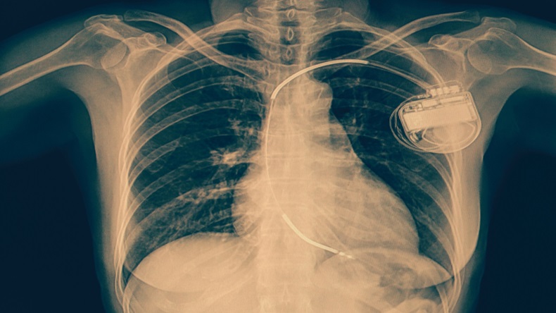 x-ray chest a human 67 year old,showing Automated Implantable Cardioverter-Defibrillator, AICD pacemaker implant in chest body , process in vintage tone. - Image 