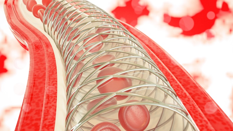 Angioplasty with stent placement- 3D rendering - Illustration 