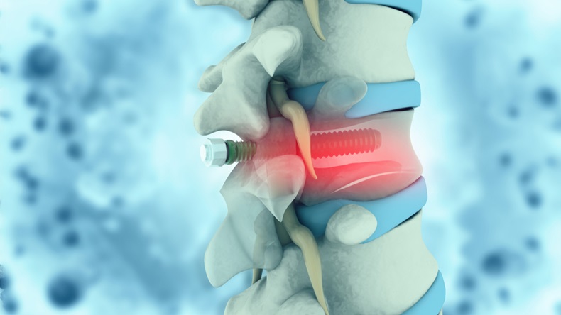 Spinal implant