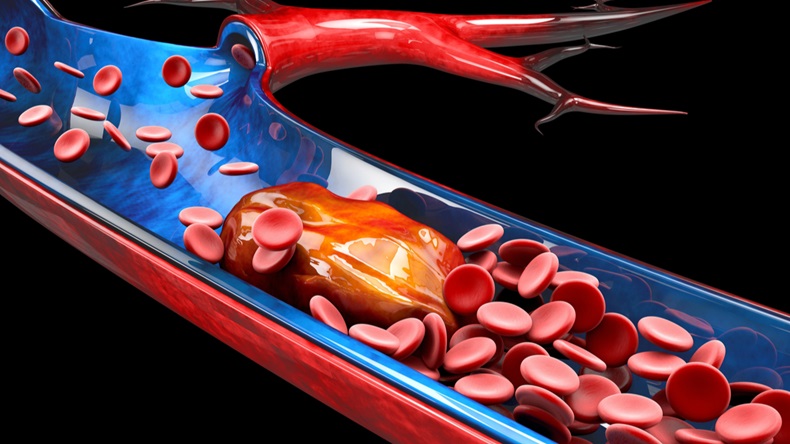 3d Illustration of Deep Vein Thrombosis or Blood Clots. Embolism. - Illustration 