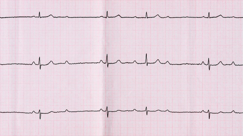 Emergency Cardiology. ECG with atrioventricular block (AV block) II degree type Mobitts I - Image 