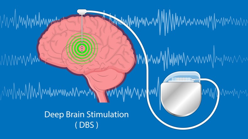 deep brain stimulation DBS Parkinson's disease PD condition major neural stimulator pulse IPG neurological wave implanted