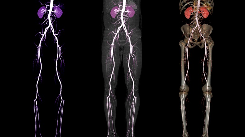 Comparison of CTA femoral artery run off 3D rendering image of femoral artery with kidney for Patients Presenting with Acute or Chronic Peripheral Arterial Disease.