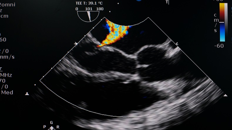Echocardiography image of atrial septal defect (ASD)