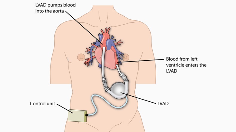 Left ventricular assist device attached to the left ventricle of the heart and the aorta