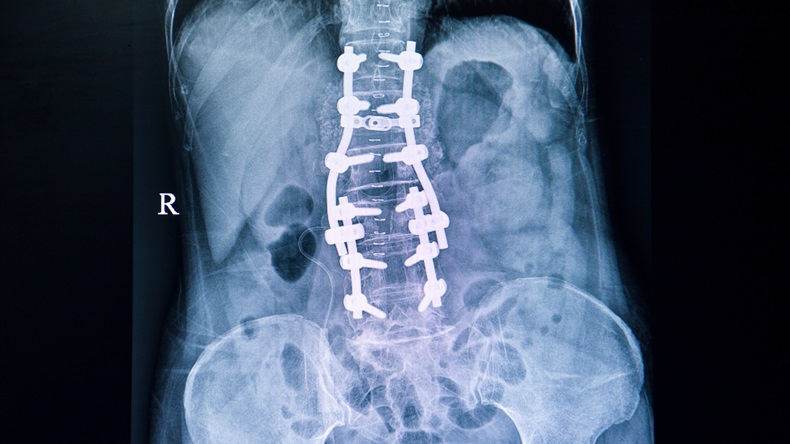 Xray film of a back of a patient who had spinal surgery showing spinal defects from laminectomy at L2-L5 which were fixed with metallic orthopedic device.