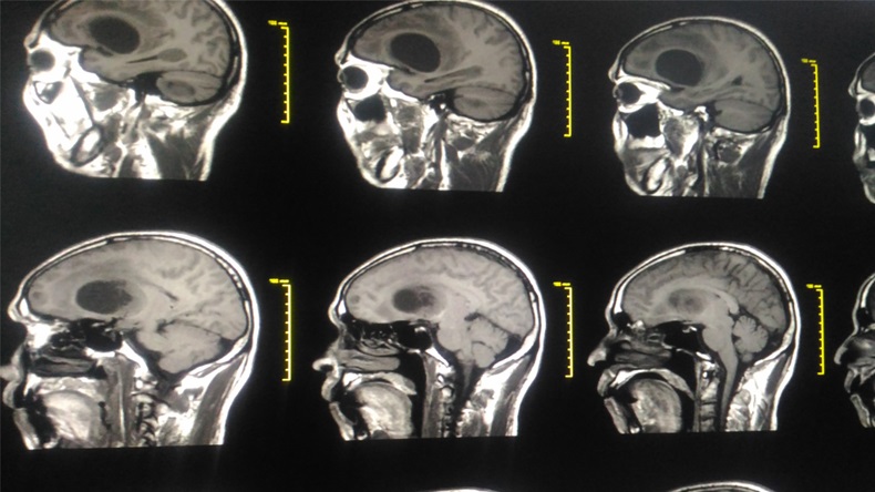 Soft and blurry image:Medical image MRI Brain showing There is diameter cystic mass or tumor at Left frontal lobe Glioblastoma at Lt frontal lobe with metastasis, brain metastases.