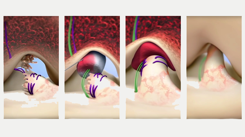 Miach Orthopaedics Bridge-Enhanced™ ACL Repair (BEAR™) Implant process