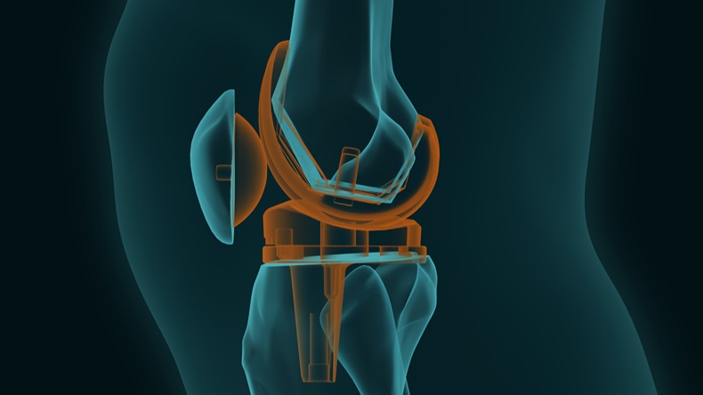 Knee arthrosplasty 