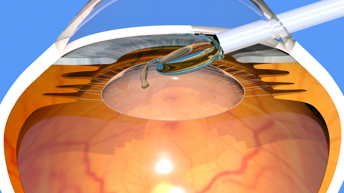 Eye lens alcon cigna and advantage 2000