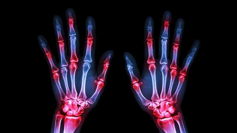 film x-ray both human's hands and arthritis at multiple joint