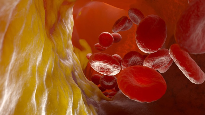 Illustration of cholesterol plaque in the artery with flowing blood cells