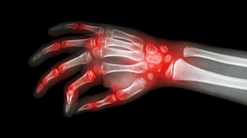 Rheumatoid arthritis , Gouty arthritis ( Film x-ray hand of child with arthritis at multiple joint ) - Image ID: F83CXB