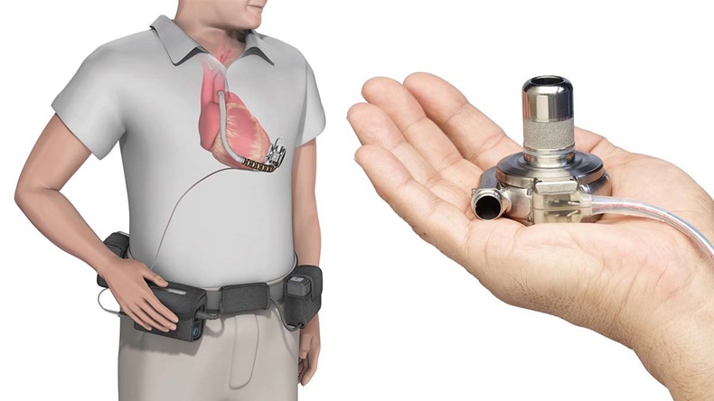 An illustration of Medtronic's HeartWare device being worn and a photo of the pump
