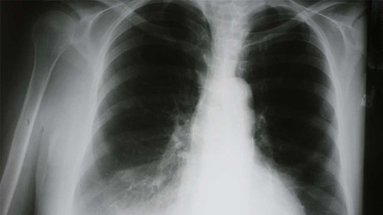 X-ray of COPD_1200
