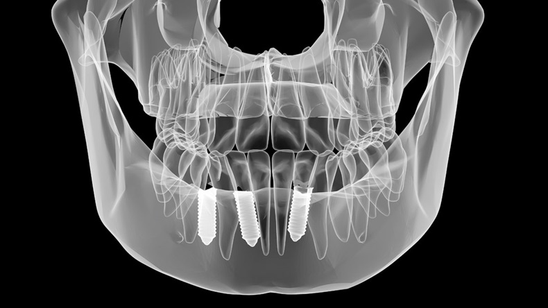 Dental implant and teeth. x-ray view