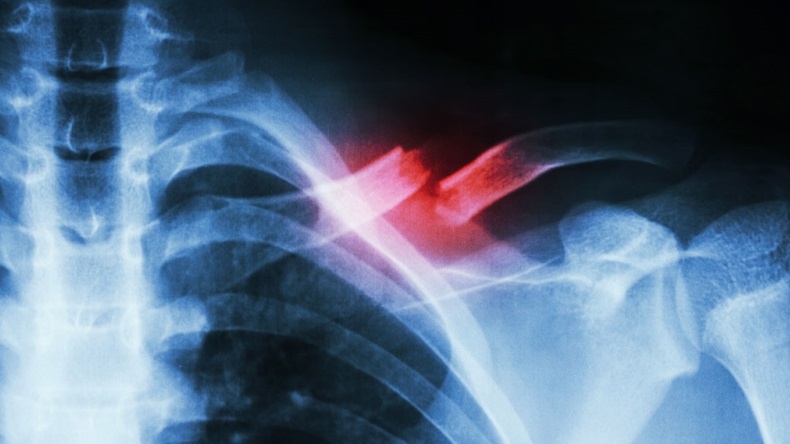 Shoulder fracture