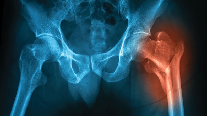X-ray image of the both hip showing right femoral neck fracture 