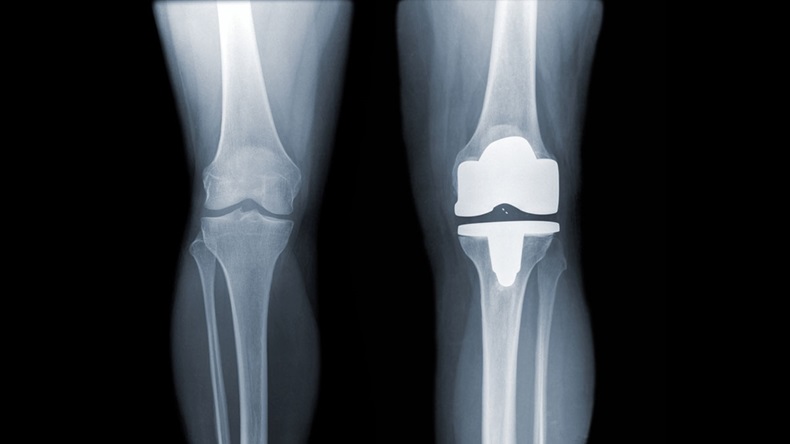knee and knee with total replacement x-ray image ob black background - Image 