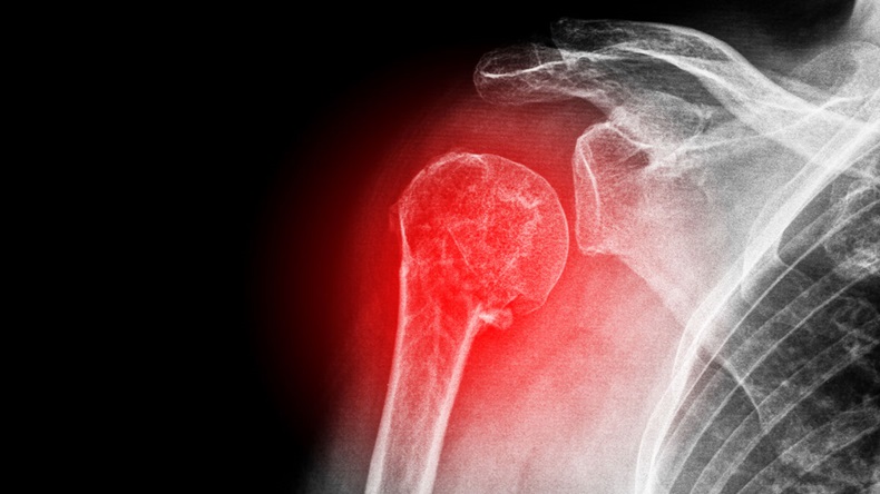 X-ray of a sore shoulder
