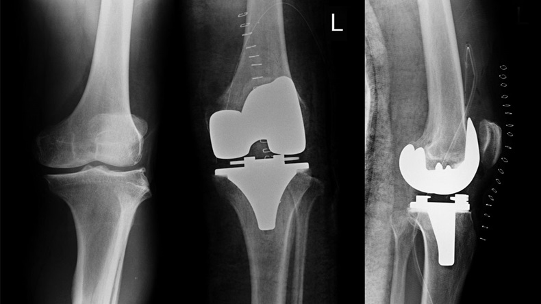 xray left knee and show pre-post operation total knee replacement