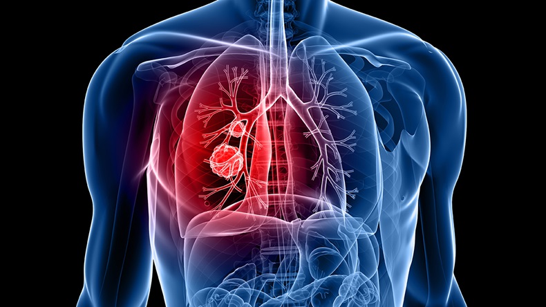 Lung cancer (Sebastian Kaulitzk/Shutterstock.com)